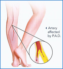 Peripheral artery disease